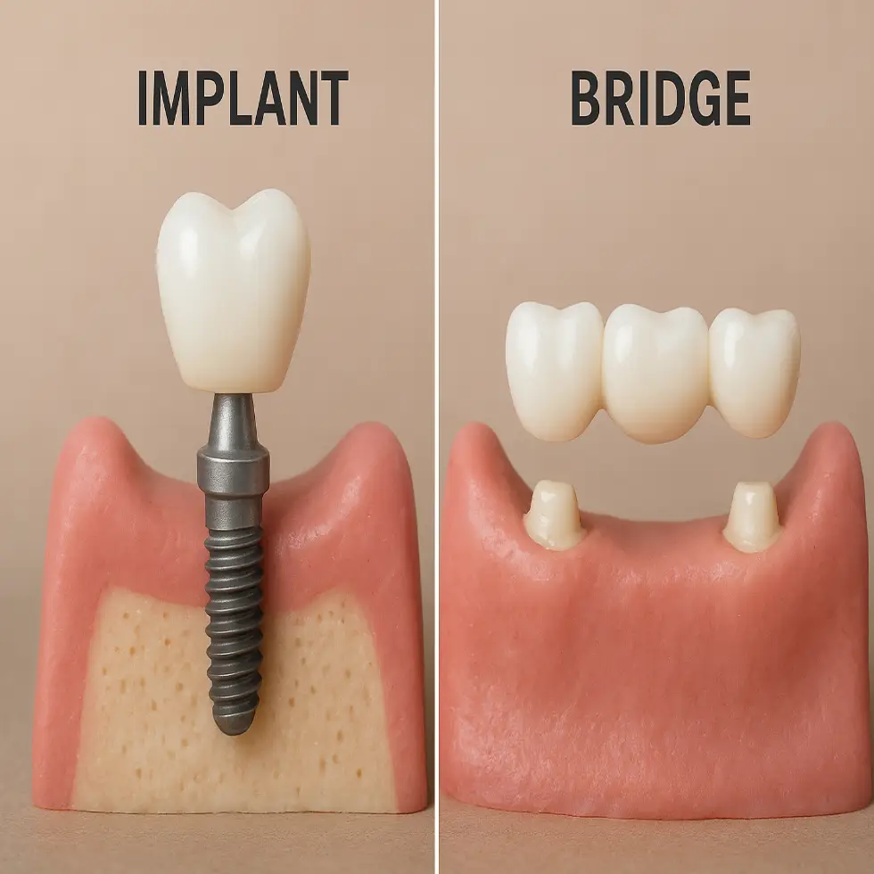 تفاوت ایمپلنت و بریج دندان