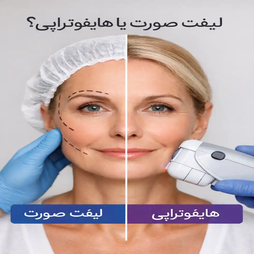 لیفت صورت بهتر است یا هایفوتراپی؟