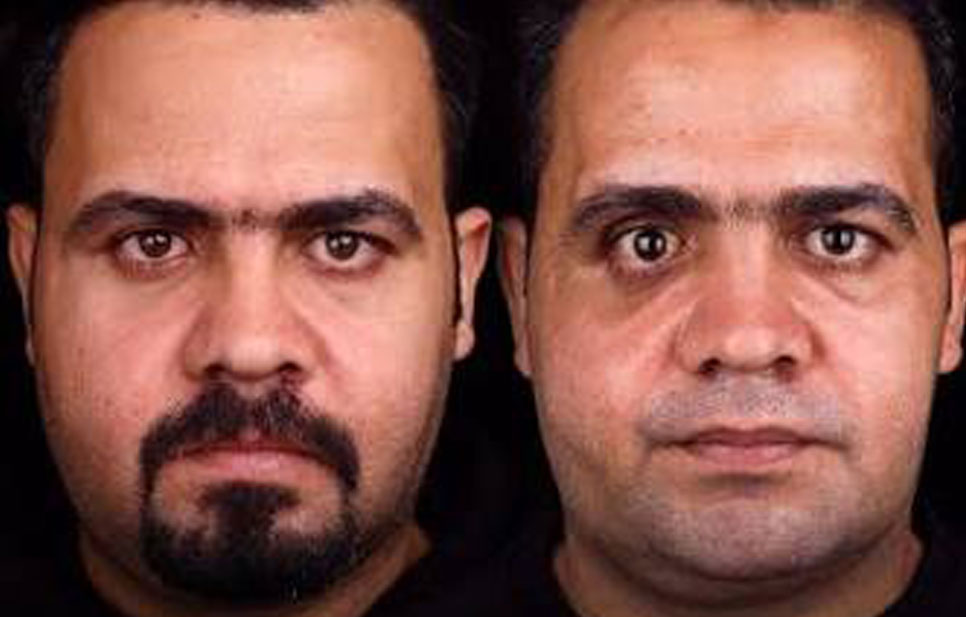 تحلیل موردی از بازسازی پیچیده شکستگی‌های صورت